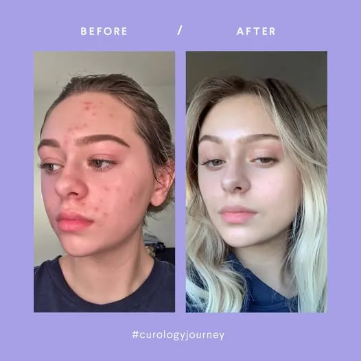 Curology Before and After - User-Generated Content - Growbo